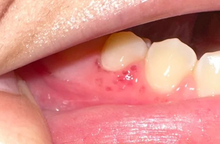 gingivitis symptoms gingivitis symptoms