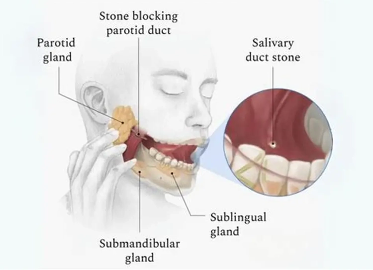 tonsil stones symptoms