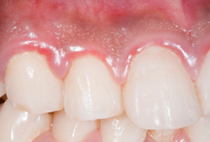 Tiny Red Dot on Gum Above Tooth: Causes, Seriousness & What to Do