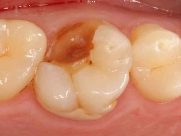 how to fix a chipped molar