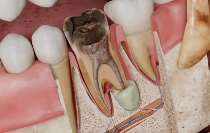 periapical abscess treatment periapical abscess treatment