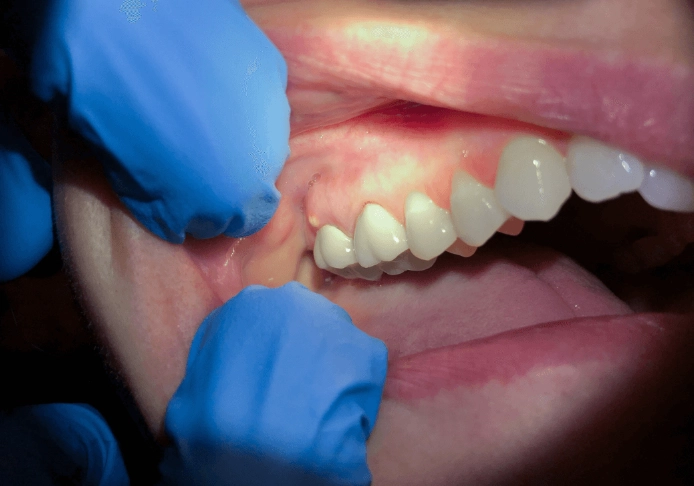 tooth abscess home remedy tooth abscess home remedy