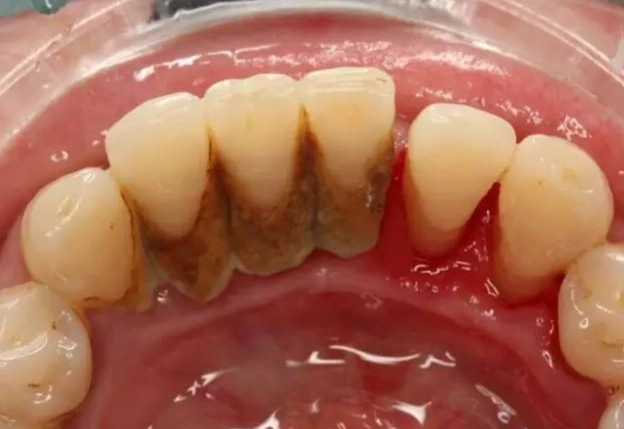 what are tonsil stones