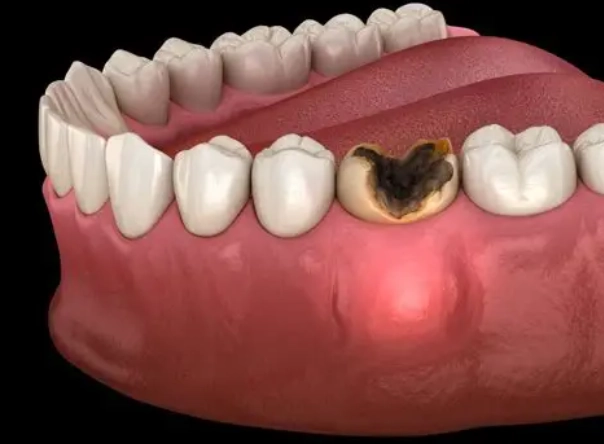 Infected Tooth? Your Complete Guide to Symptoms, Pain Relief & Treatment