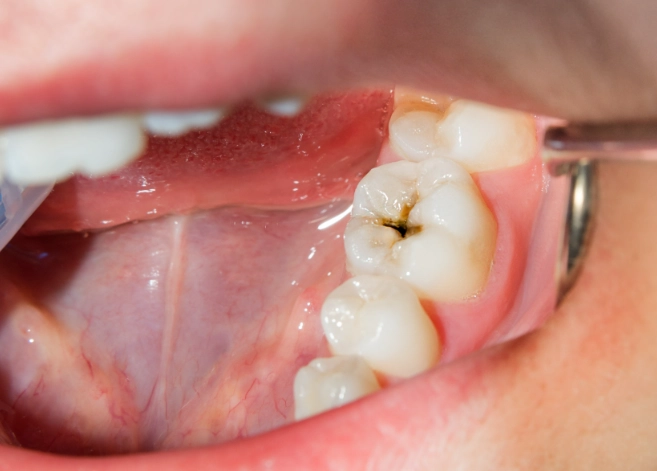 early signs of tooth decay