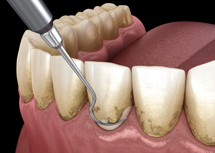 periodontal scaling recovery