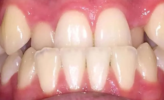 adult underbite braces