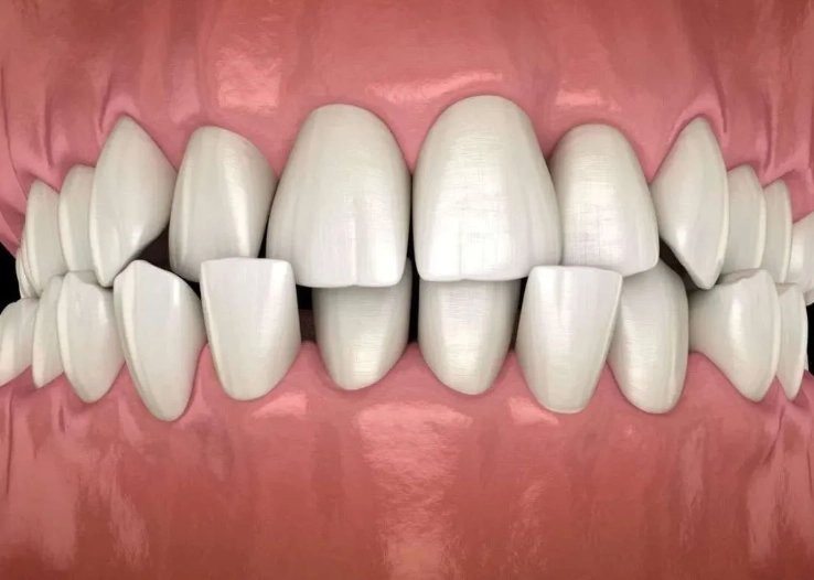 mild underbite treatment