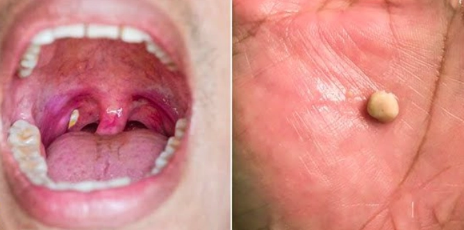 how to remove tonsil stones