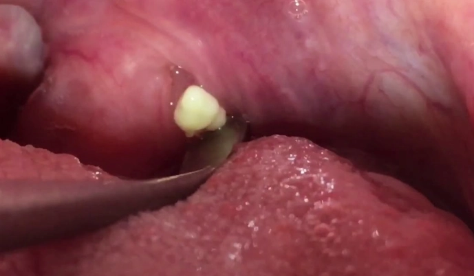 How to Remove Tonsil Stones: Safe & Effective Home Methods and Prevention