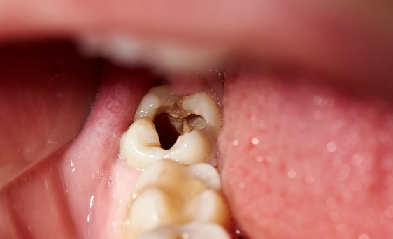 how to know if you have a cavity