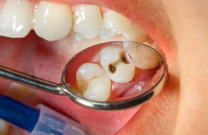 How to Tell If You Have a Cavity: 7 Signs You Shouldn't Ignore