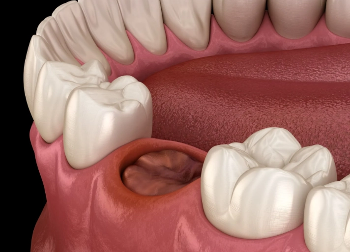 dry socket symptoms dry socket symptoms