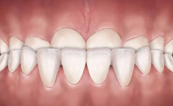Understanding and Treating Mild Underbite: A Complete Guide