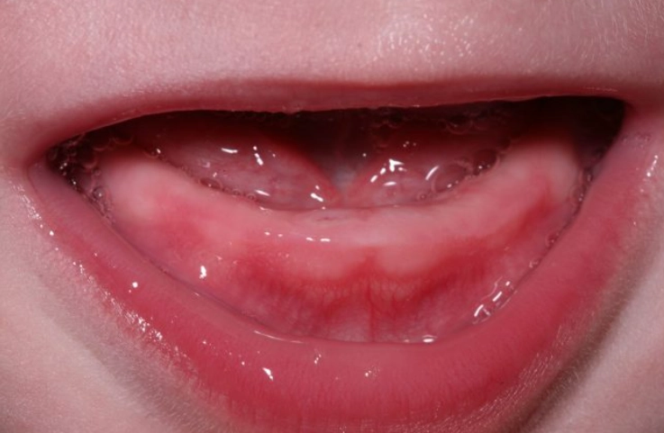 teething pain worst months