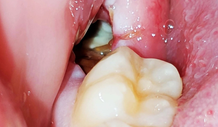 Day 7 After Wisdom Teeth Removal: Is It Dry Socket or Normal Healing?