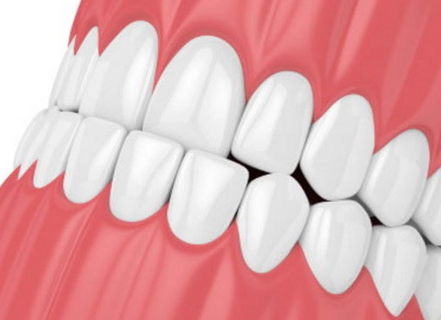 underbite correction without surgery