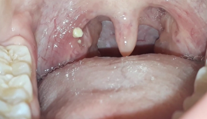 get rid of tonsil stones