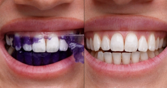 Fast Teeth Whitening Reviews: What Actually Works in 2024?