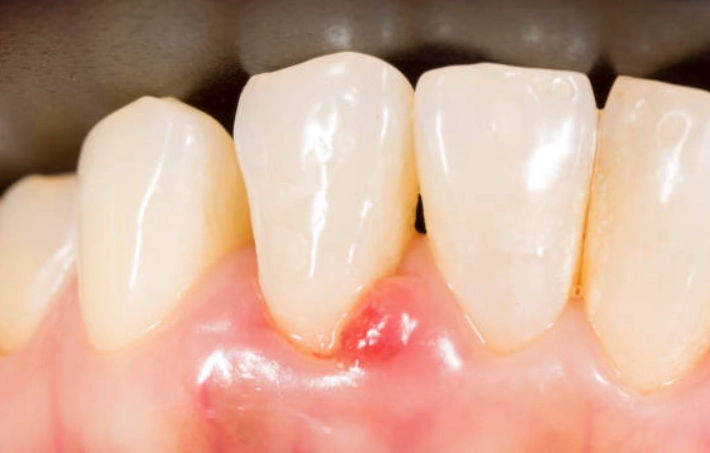 gum disease symptoms