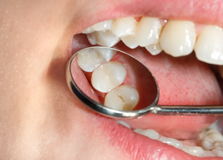 home remedies for cavity pain