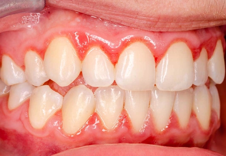 Gingivitis Red Spot on Gums: Causes, Treatment, and When to Worry