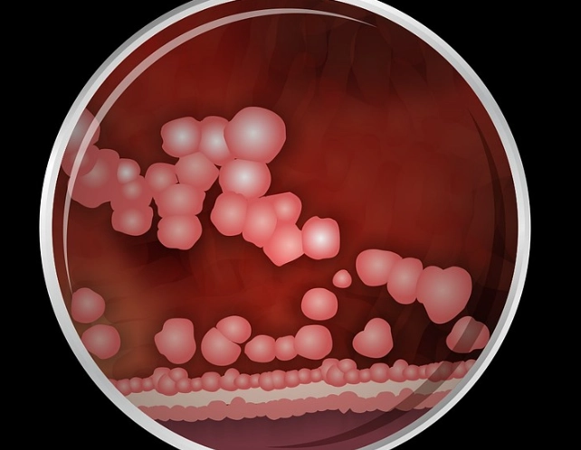 Porphyromonas Gingivalis Treatment: A Complete Guide to Beating Gum Disease