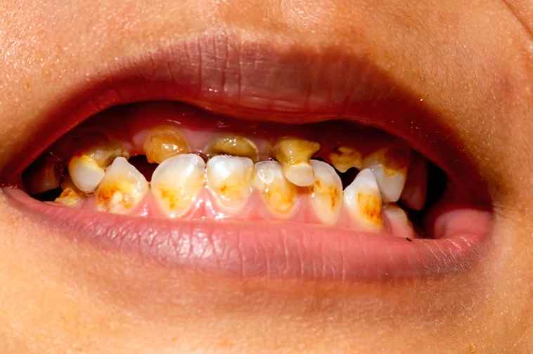 Milk Tooth Decay: Consequences, Risks, and What Parents Must Do