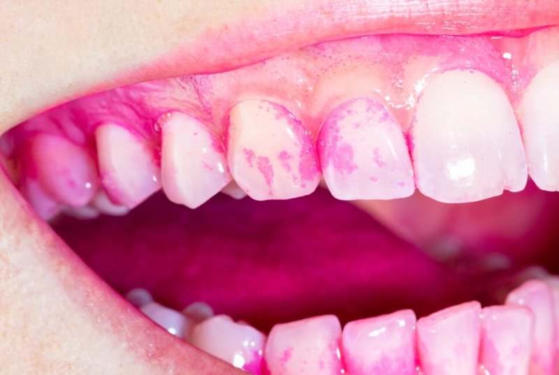 how long does it take for gums to heal after a deep clean