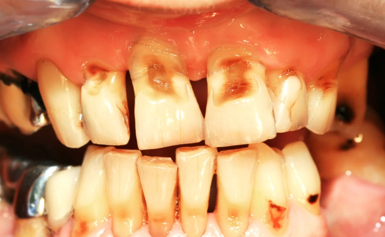 citric acid tooth damage