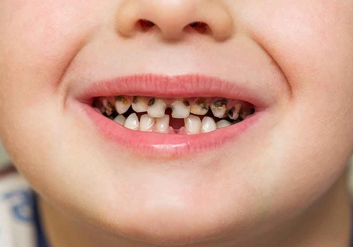 baby teeth cavities