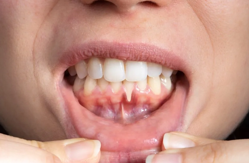 How Do You Treat Receding Gums in Children? A Complete Parent's Guide