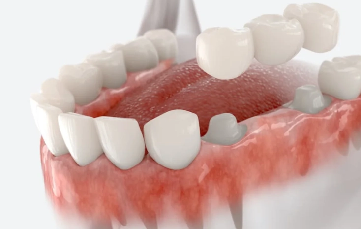 Crown Recementation Cost: How Much to Glue a Crown Back On?
