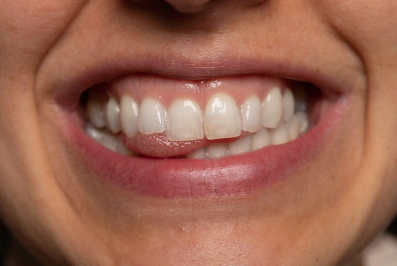 gum recession treatment kids gum recession treatment kids