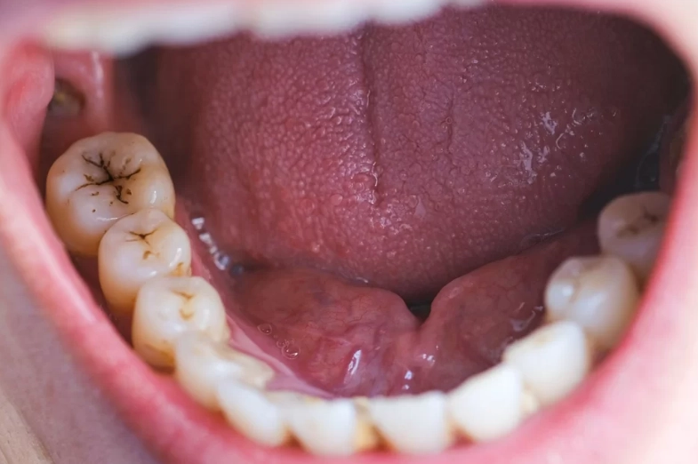 How to Fix Milk Rot Teeth: Expert Guide to Treatment & Prevention