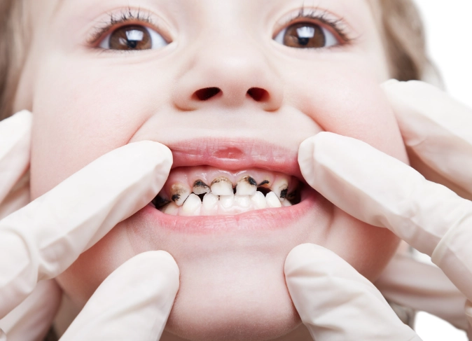 decayed milk teeth