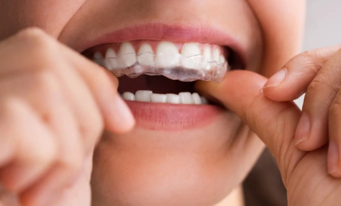 teeth grinding guard