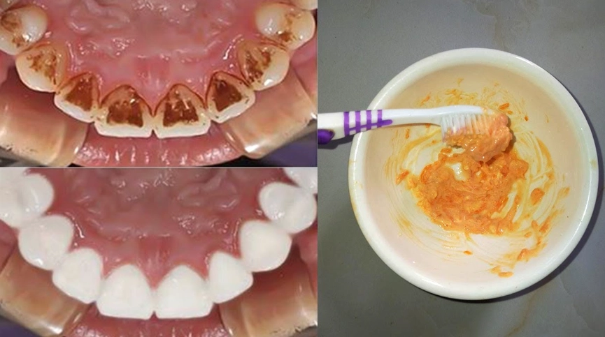 baking soda teeth whitening
