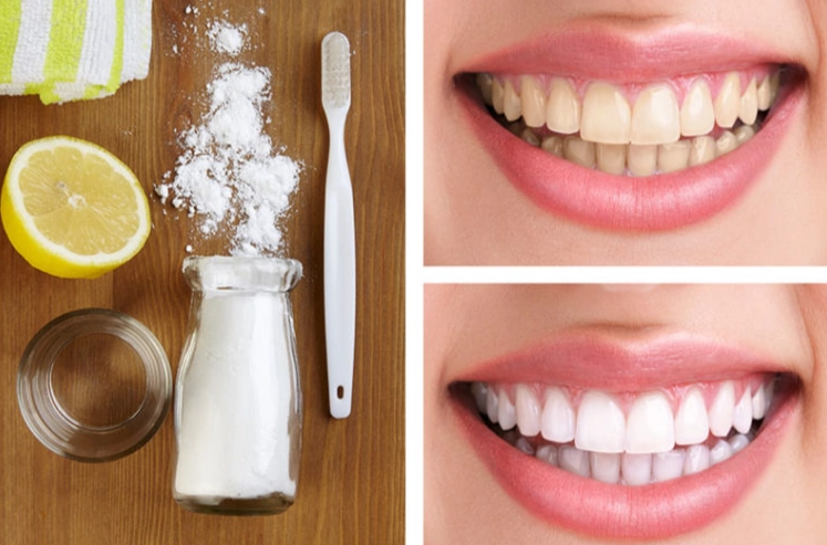 teeth whitening methods