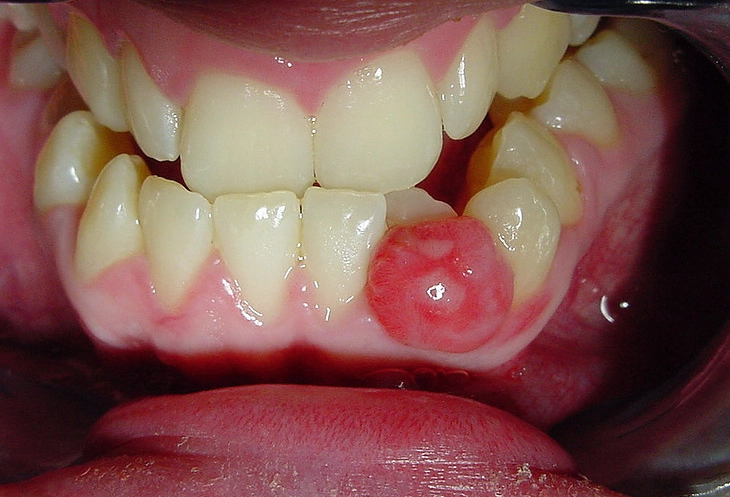 hard lump inside mouth lower jaw hard lump inside mouth lower jaw