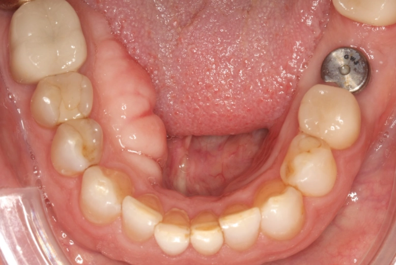 Do Dental Tori Require Treatment? A Complete Guide to Causes & Surgery