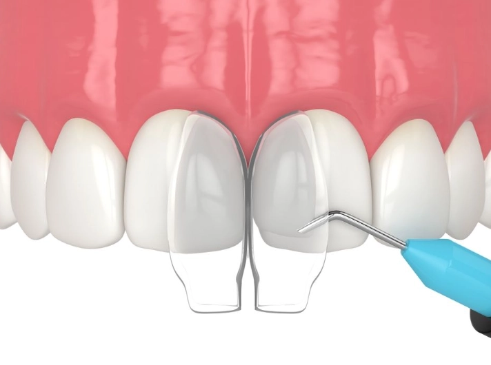 torus palatinus torus palatinus