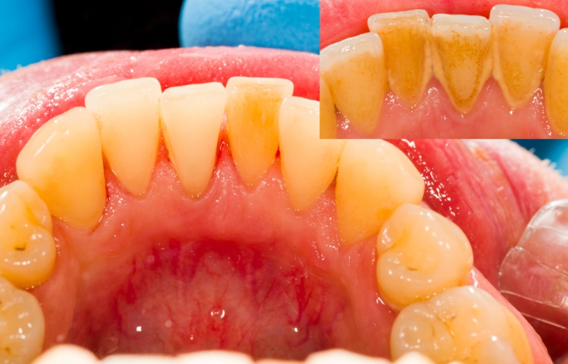 tartar plaque removal