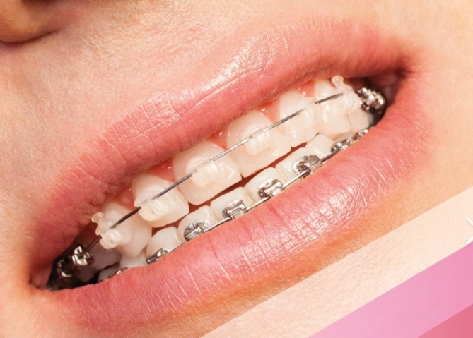 ceramic vs metal braces
