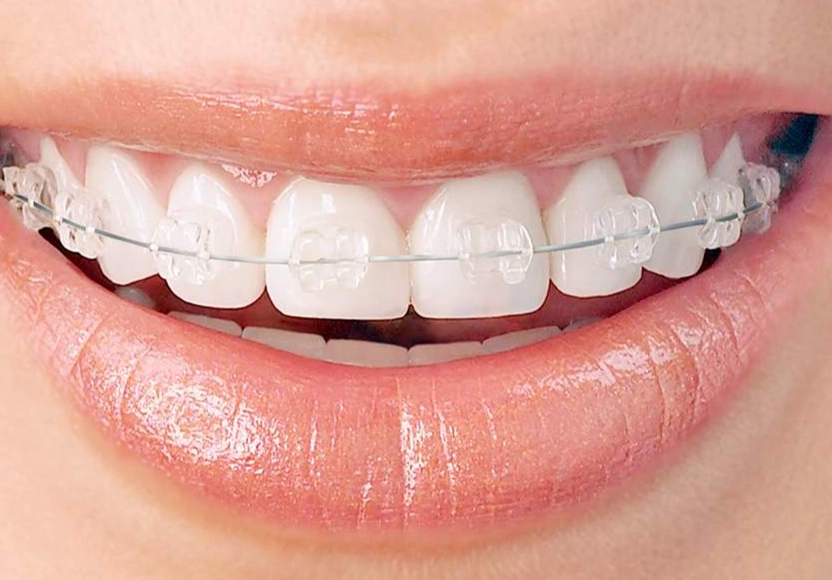 ceramic vs metal braces