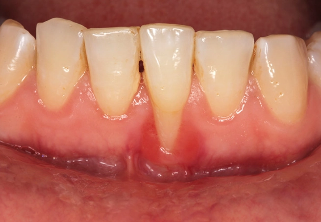 can receding gums grow back
