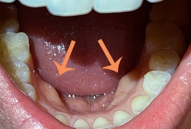 Hard Lump Inside Mouth Lower Jaw: Causes, When to Worry & Next Steps