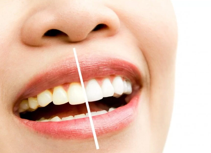 best ADA approved teeth whitening