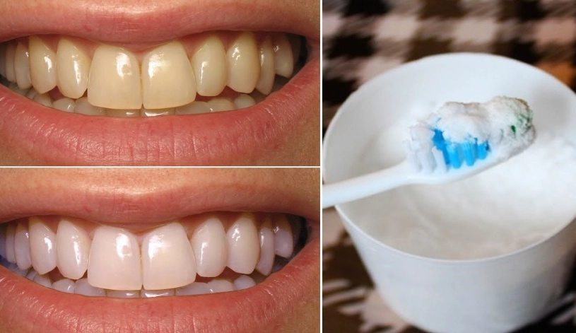 How to Whiten Teeth with Baking Soda: A Safe & Effective Guide