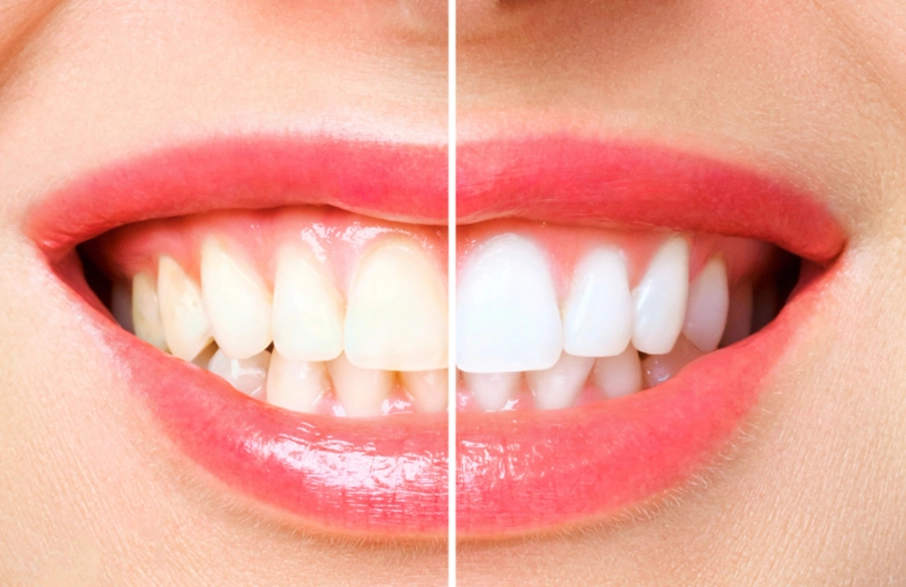 How Can I Whiten My Teeth Safely? Ultimate Guide to All Methods
